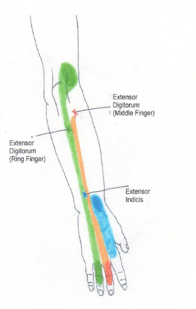 Neck, Shoulder, Arm, and Hand Trigger Point Chart  © Copyright